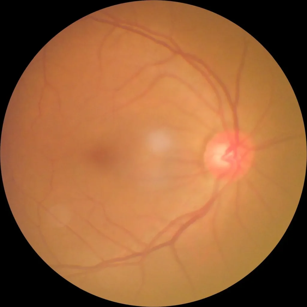 Retina photograph taken during a home eye test